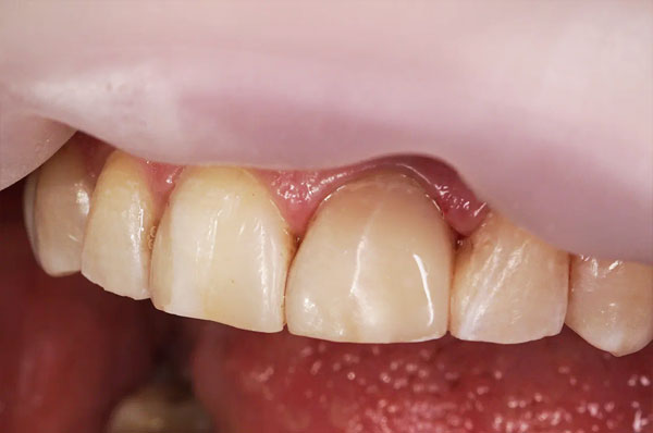 После лечения переднего зуба